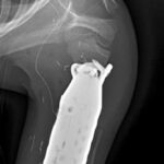 One-of-a-Kind Limb-Sparing Surgery Provides New Hope for a Young Bone Cancer Patient Using 3D Printed Prosthetic