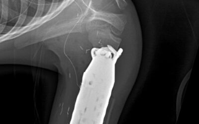 One-of-a-Kind Limb-Sparing Surgery Provides New Hope for a Young Bone Cancer Patient Using 3D Printed Prosthetic