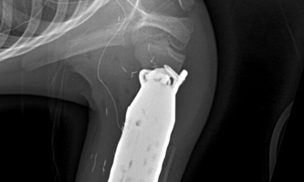 One-of-a-Kind Limb-Sparing Surgery Provides New Hope for a Young Bone Cancer Patient Using 3D Printed Prosthetic