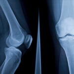 Mandala Medical Group Announces Groundbreaking Limb‑Saving Procedure by Dr. James C. Wittig